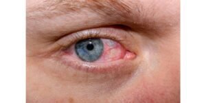 احمرار العين والتهابها