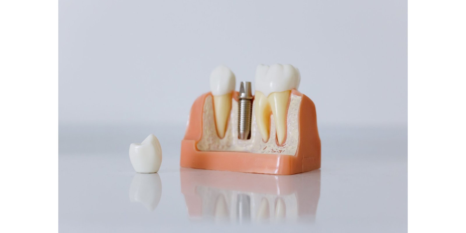 زراعة الأسنان