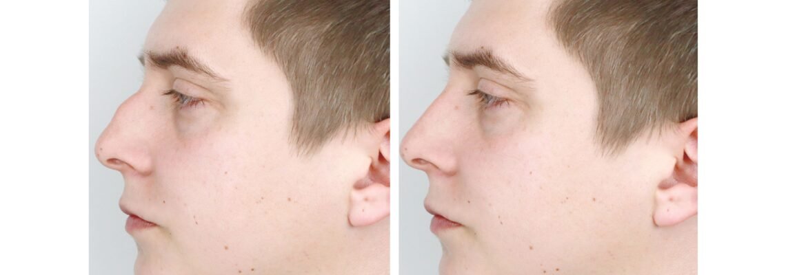 تجميل الانف أنواعها ومعلومات عليك معرفتها