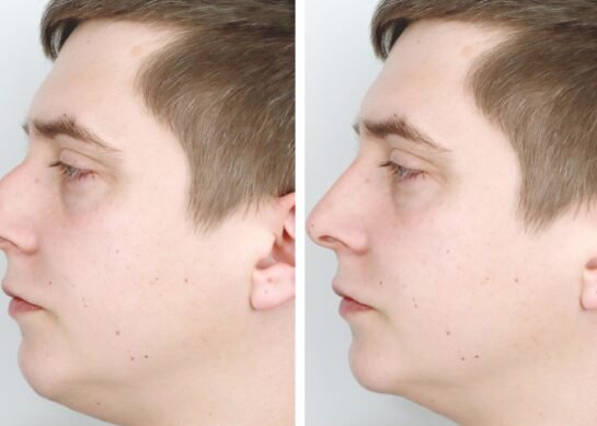 تجميل الانف أنواعها ومعلومات عليك معرفتها