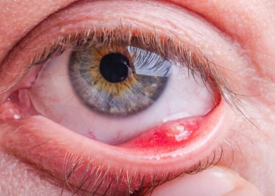 أمراض العيون جميع المعلومات التي تريد معرفتها