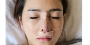 إزالة الغرز بعد عملية تجميل الأنف