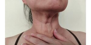 عملية شد الرقبة التجميلي