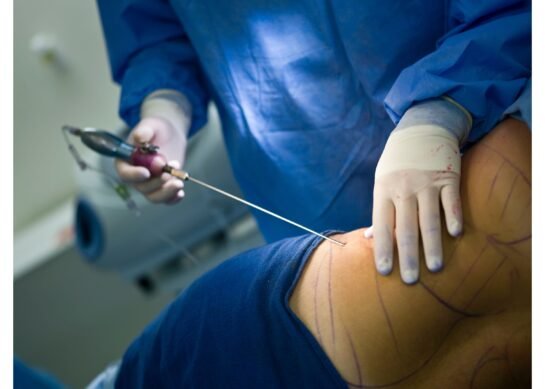 شفط الدهون جميع المعلومات عن هذه العملية