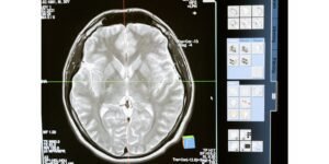 ورم دموي في المخ