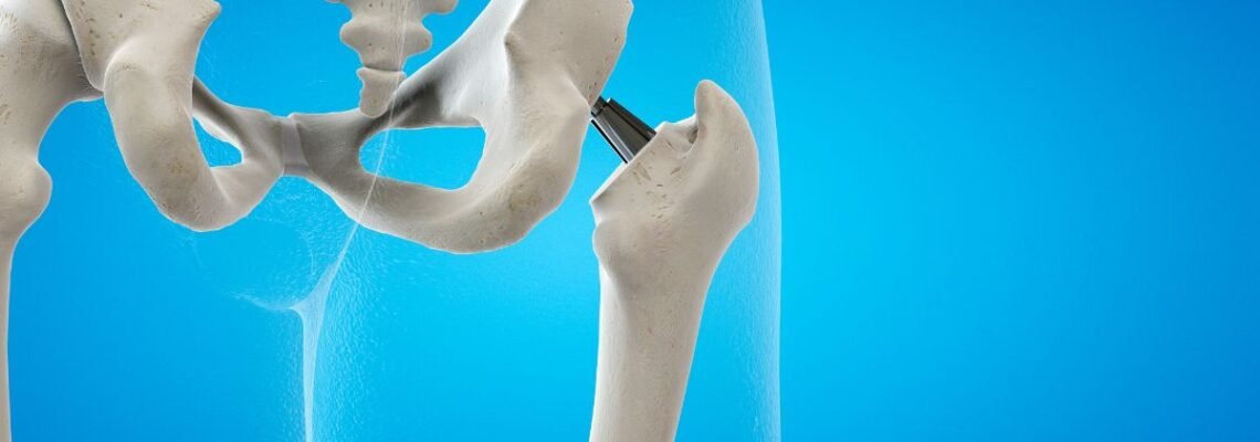 جراحة استبدال مفصل الورك