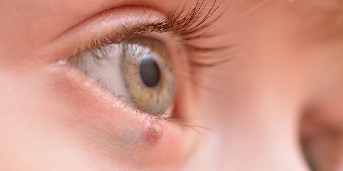  الانتفاخات تحت العينين