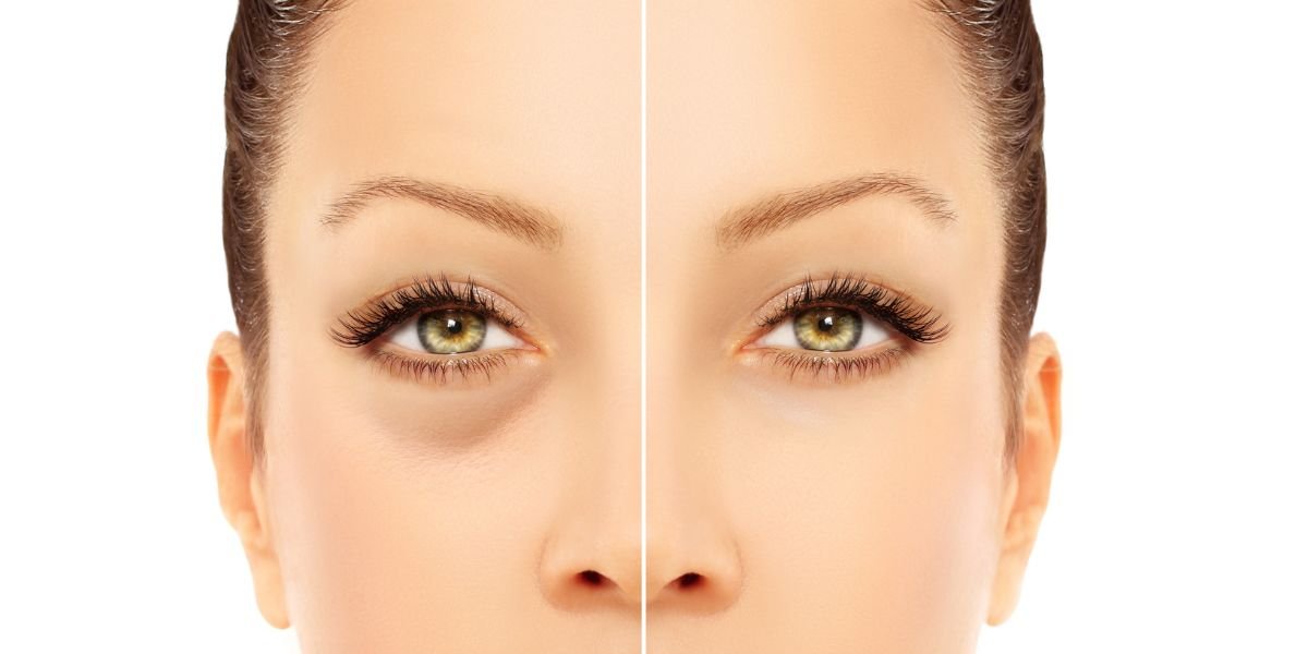  الانتفاخات تحت العينين