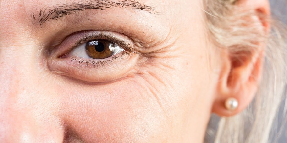 الانتفاخات تحت العينين