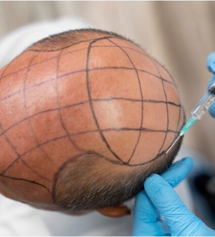 عيادات زراعة الشعر