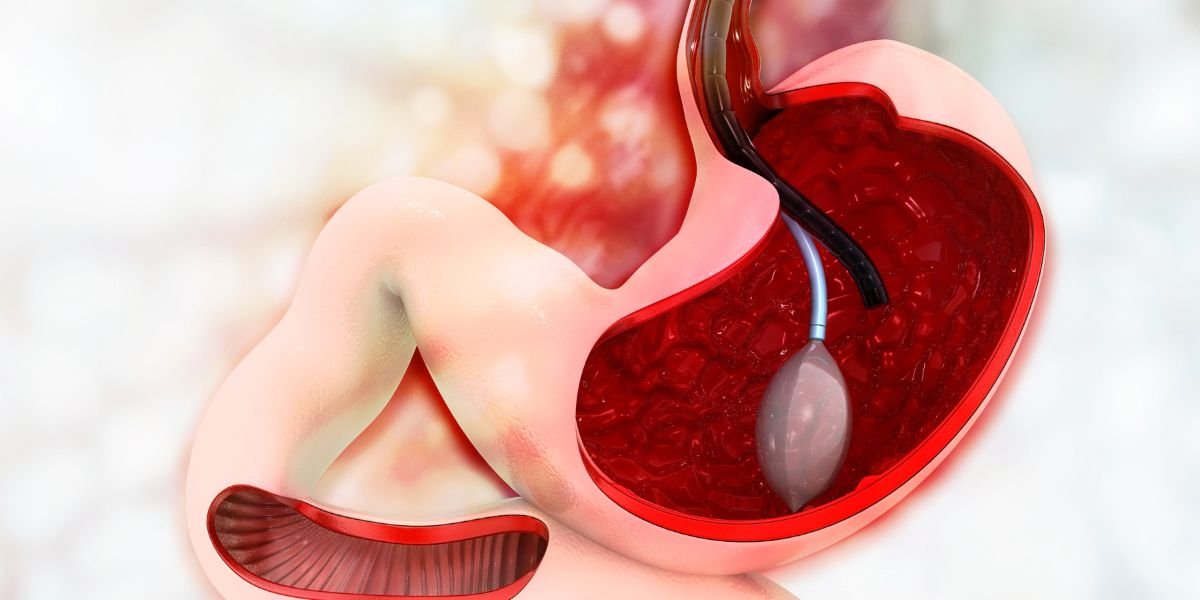 Gastric balloon