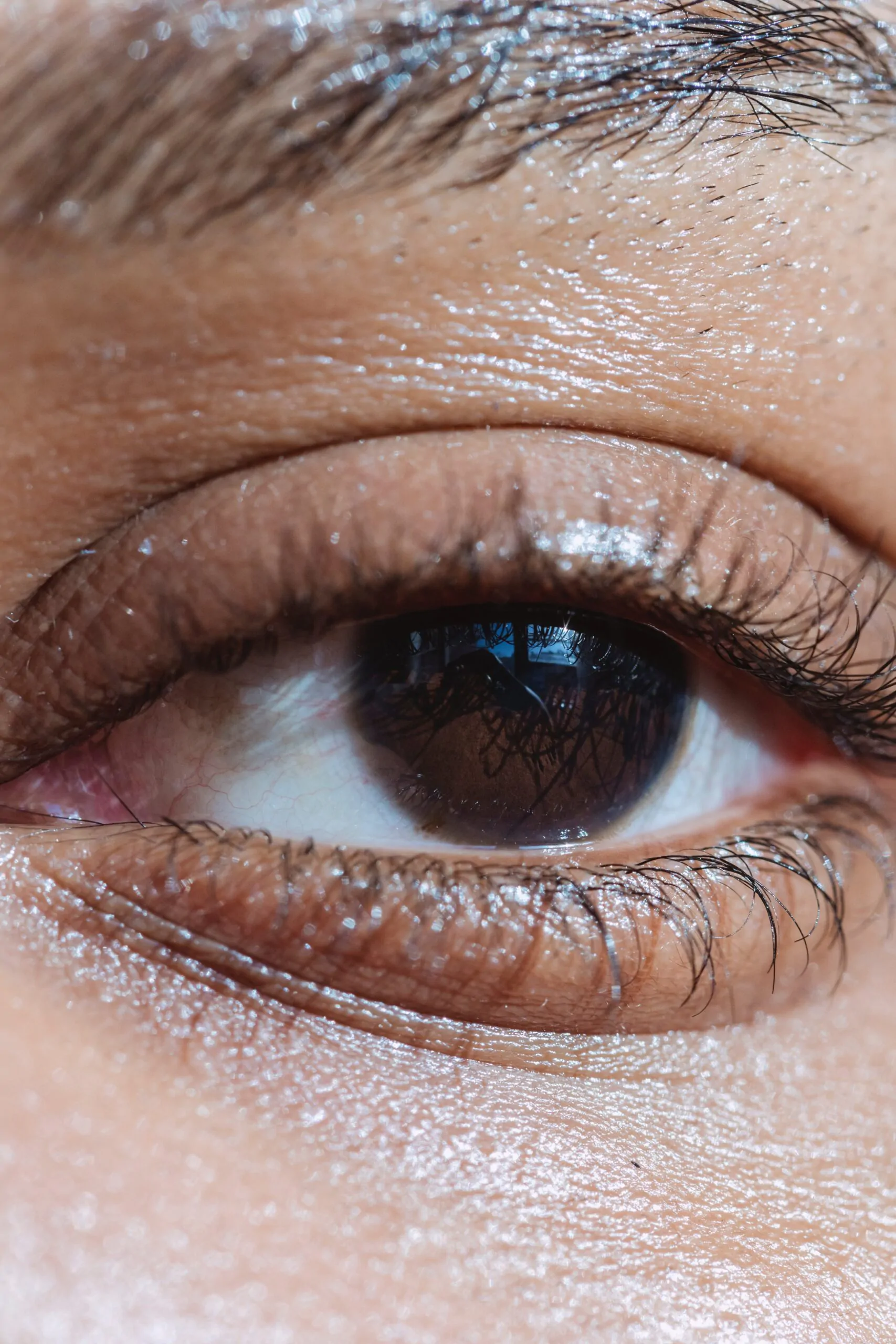 أسباب تدلي الجفن Drooping eyelid وعلاجه