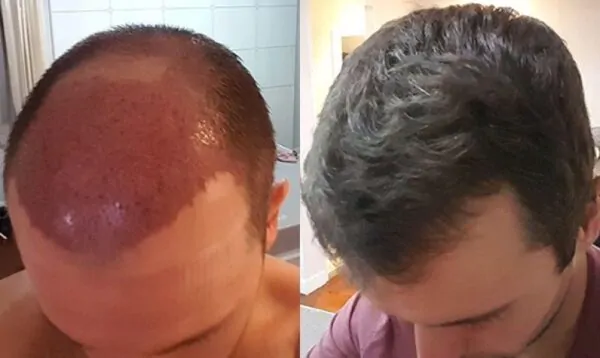 كل ما تحتاج معرفته حول زراعة الشعر