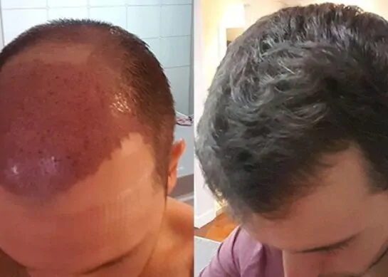 كل ما تحتاج معرفته حول زراعة الشعر