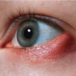 الدمل في العين
