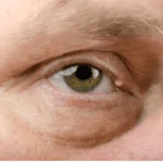 جواب: يُعزى ظهور الكيس الدهني في العين عادةً إلى تجمع الدهون والزيوت في الغدد الدهنية داخل الجفن.