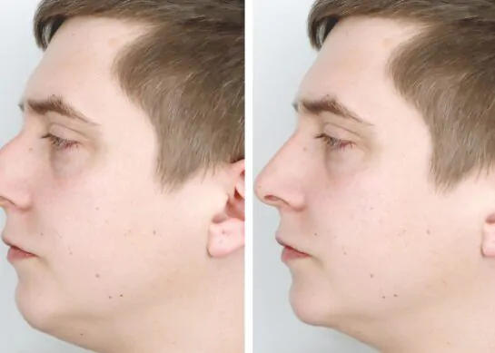 تجميل الانف أنواعها ومعلومات عليك معرفتها