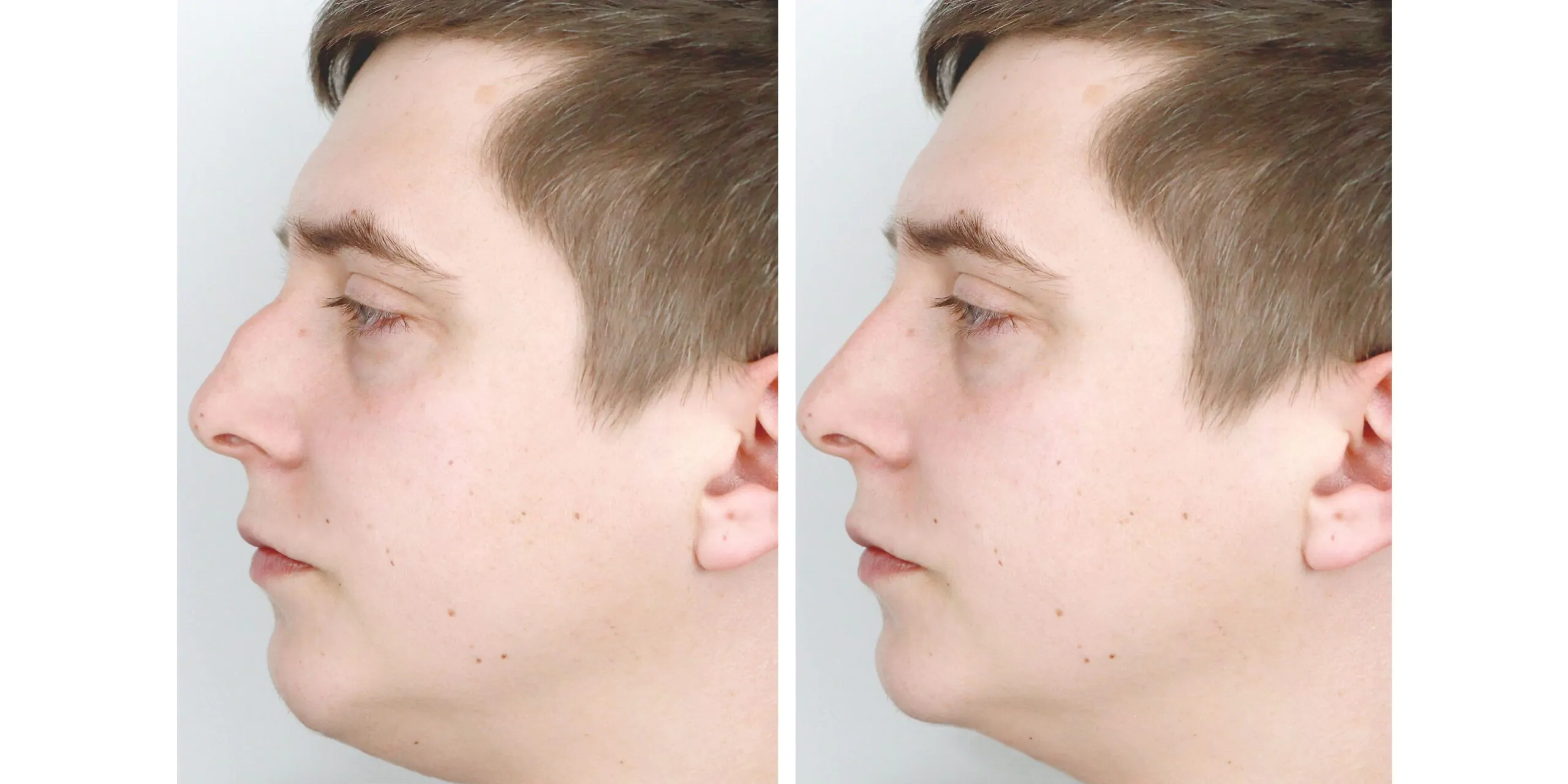 تجميل الأنف