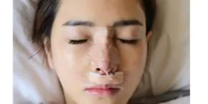 إزالة الغرز بعد عملية تجميل الأنف