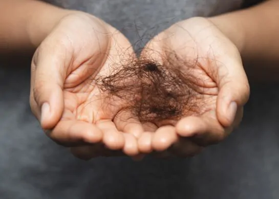 زراعة الشعر كل ماتريد معرفته عنها