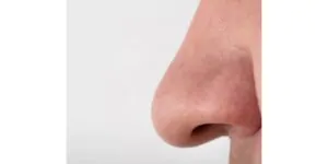 عمليات تجميل الانف العريض