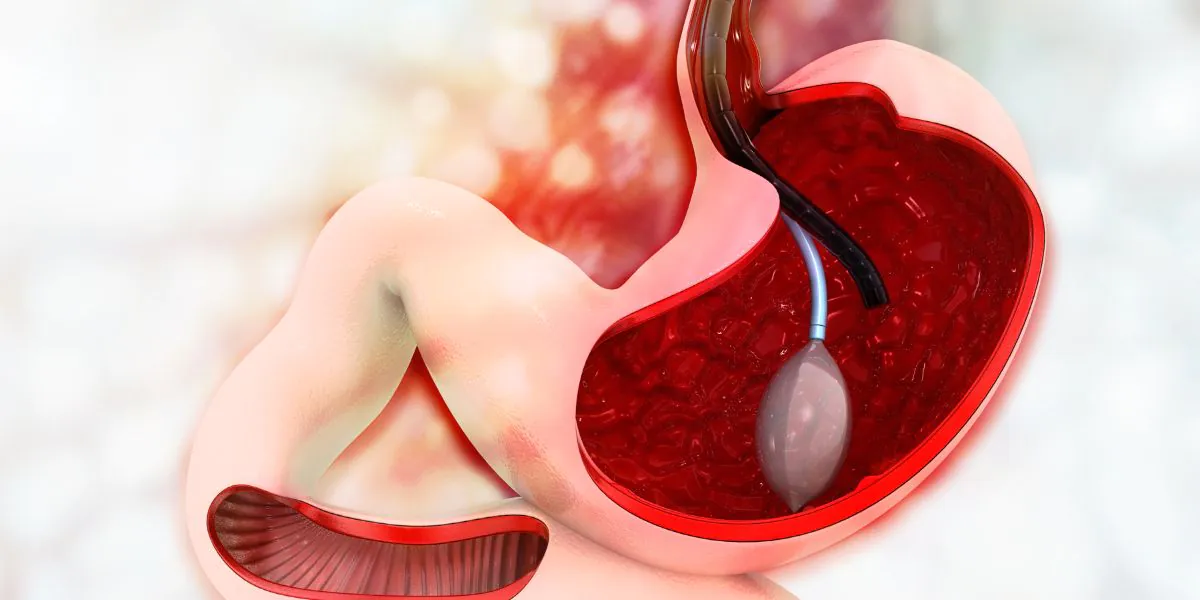 Gastric balloon